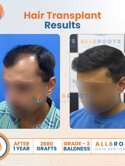 A one-year result for a Grade 3 baldness case using 2680 grafts. These images show the transformation from multiple angles, highlighting the restored density and the clean, natural hairline I designed.