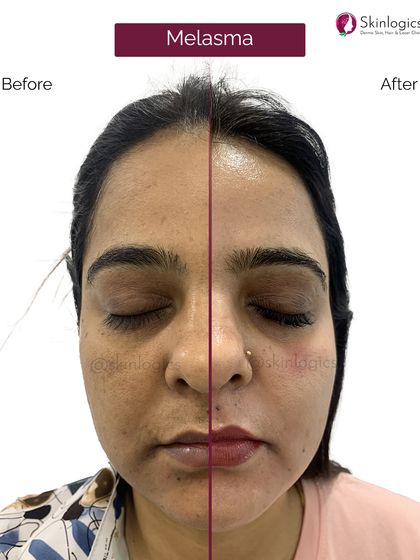 This split-screen before and after image provides a direct comparison of a patient's face, half showing the initial melasma and the other half showing the clearer skin post-treatment.