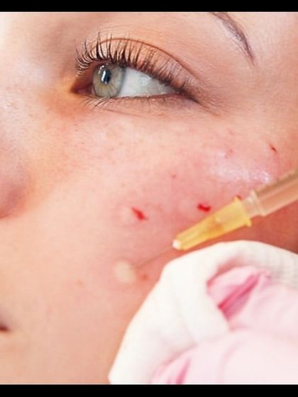 A close-up of a PRP (Vampire Facial) treatment. The micro-injections deliver growth factors directly into the skin, triggering deep cellular repair and rejuvenation for a refreshed and youthful appearance.