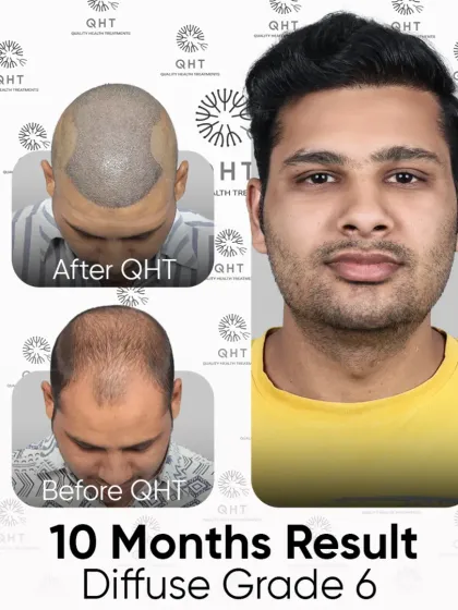 A 10-month result for a Diffuse Grade 6 patient. 5000 grafts were used to achieve this natural, dense look.