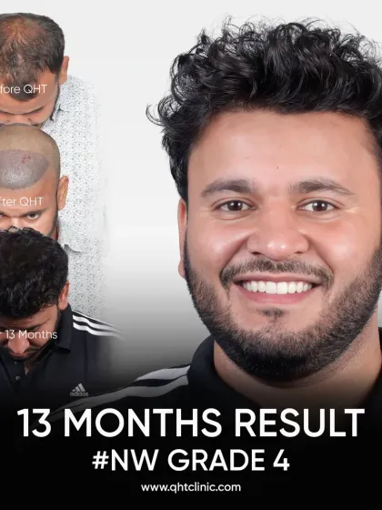 From Grade 4 baldness to a bold comeback in 13 months. We used 3800 grafts to recreate the hairline and add density to the frontal and mid-scalp.