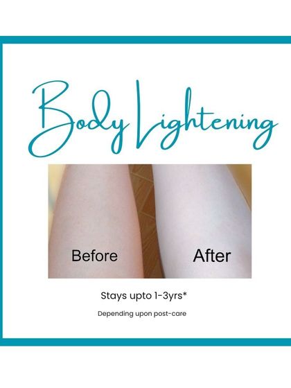My body lightening treatment provides a visible difference in skin tone, helping to reduce tan and dark patches for a uniform look that can last for years.