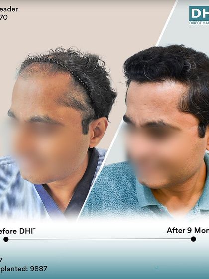 A side-profile view of the same client's 9-month progress. The restored hairline and increased thickness are clearly visible, showcasing a natural and youthful result.