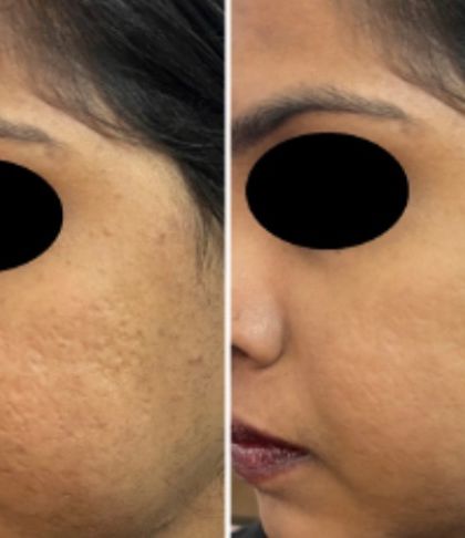 Here is another example of successful acne scar revision. My approach focuses on stimulating the skin's natural healing process to fill in pitted scars and create a more uniform, radiant complexion.