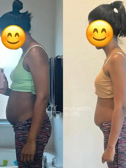 This client wanted to get rid of her postpartum weight and get fitter. She lost 5 kgs in the first month and went on to tone her body and improve her PCOD symptoms with a plan that fit her busy schedule.