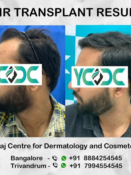 This side-profile before and after shows a significant improvement in hair density from the hairline to the mid-scalp, resulting in a much fuller look.