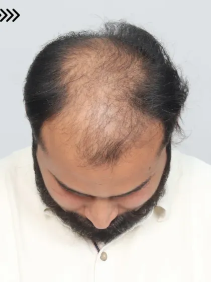 The before, marking, and after stages of a hair transplant, showing the clear plan and the resulting growth.