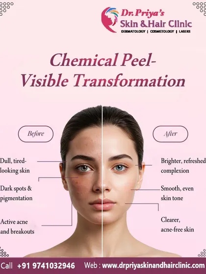 This image demonstrates the visible transformation possible with a chemical peel. The treatment effectively addresses dullness, dark spots, and active acne by exfoliating the skin's surface, revealing a brighter, clearer, and more even-toned complexion.