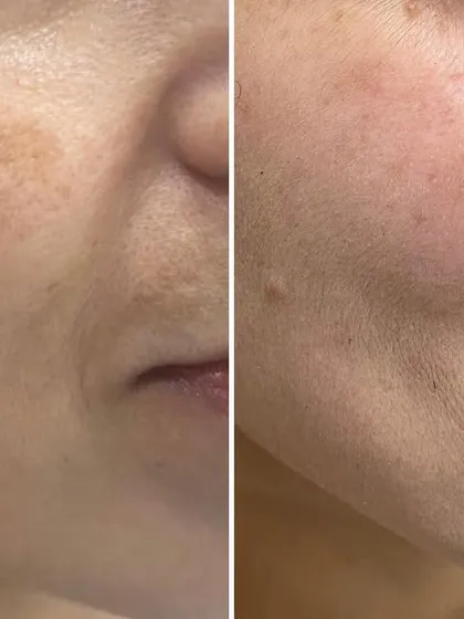 This before-and-after comparison shows a significant reduction in facial hyperpigmentation. We achieved this clearer, more even skin tone through a personalized plan combining in-clinic procedures with a consistent at-home skincare routine.