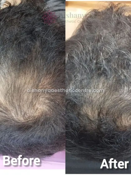 Seeing is believing. This is a typical result from my non-surgical hair growth treatments, showing significant improvement in hair density and scalp coverage after a few sessions.
