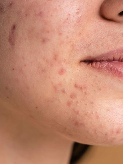 A close-up view of a patient with both active acne and early scarring. My treatment philosophy is to intervene early to control breakouts and prevent the formation of permanent scars.