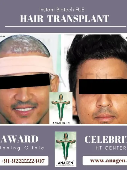 An excellent result from our Instant Biotech FUE technique, showing the patient's journey from post op to a full head of hair.