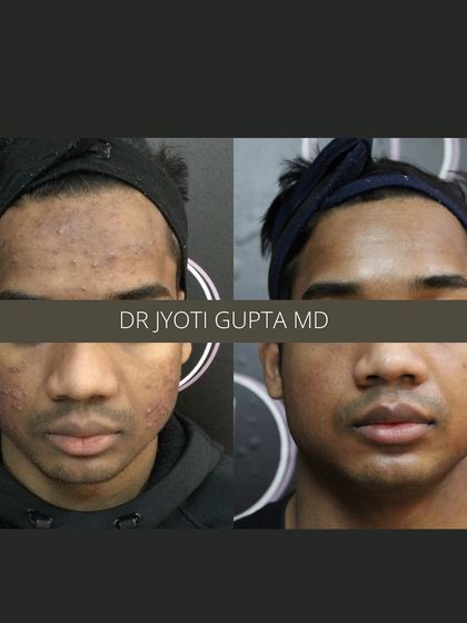 A before and after view of a patient treated for both active acne and residual scarring. The goal is to first control the breakouts and then work on smoothing the skin's texture for a clear and confident complexion.