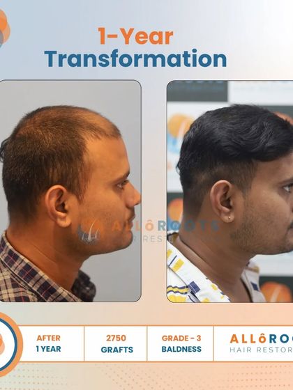 This one-year transformation for a Grade 3 baldness case was achieved with 2750 grafts. The series of photos demonstrates the significant improvement in density and hairline from every angle.