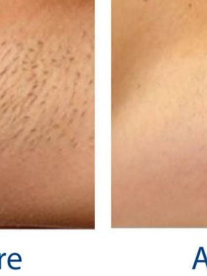 A clear before and after comparison of an underarm area treated with laser hair removal. The result is not just the absence of hair but also smoother and lighter skin, as the treatment helps reduce the pigmentation often caused by shaving or waxing.