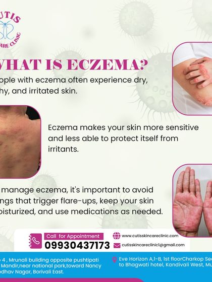 This graphic explains what eczema is, a condition causing dry, itchy, and irritated skin. We help patients manage eczema by identifying triggers, providing moisturization strategies, and prescribing medication as needed.