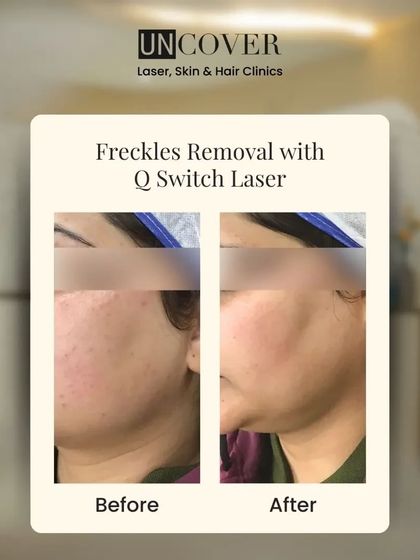 This before-and-after shows freckle removal using our Q-Switch Laser. This treatment is quick, has minimal downtime, and delivers effective, long-lasting results for clearer skin.