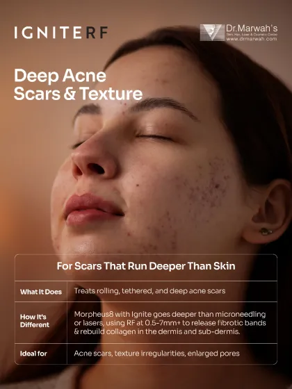 For scars that are tethered deep within the skin, we use Ignite RF powered by Morpheus8. This technology goes deeper than standard microneedling, using radiofrequency energy to release fibrotic bands and rebuild collagen in the dermis for profound textural improvement.