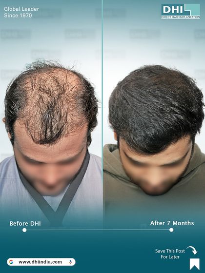 A top-down view of a 27-year-old client with Norwood Grade V hair loss, 7 months after his procedure. With 5,234 hairs implanted, the transformation in density and coverage is already outstanding.