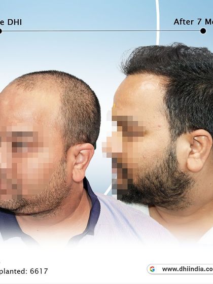 Another side-profile view of the 7-month transformation. This angle highlights the seamless integration of the new hair, creating a natural and aesthetically pleasing outcome.