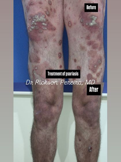 This before-and-after demonstrates the successful treatment of severe psoriasis on the legs. Biologic treatments target the root immune cause, offering significant clearance and improving overall health by reducing systemic inflammation.