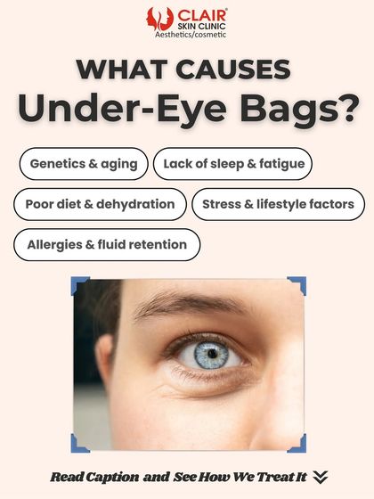 An explanation of what causes under-eye bags, from genetics and aging to lifestyle factors. We offer multiple solutions like PRP, fillers, and laser therapy to treat them.