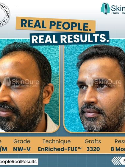 A side view of the 36-year-old patient's 8-month result. This angle demonstrates the natural flow and density of the transplanted hair, seamlessly blending with his existing hair.