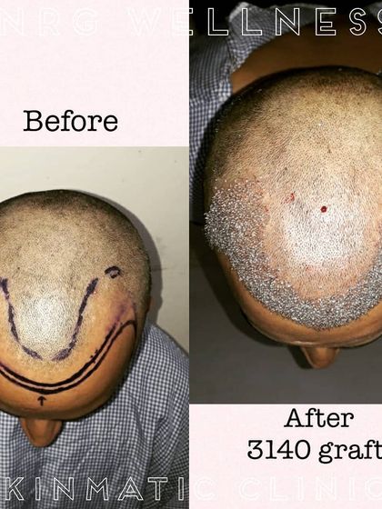 This top-down view shows a client's scalp before the procedure and right after the placement of 3140 grafts. The hairline is precisely designed, and the grafts are densely packed to ensure a full result.