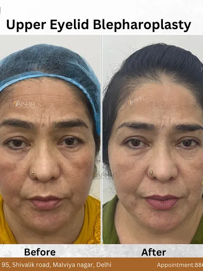 Droopy eyelids can significantly affect one's appearance and confidence. This before-and-after shows the result of an upper eyelid blepharoplasty, a minor surgical correction I perform to create a more refreshed and youthful look.