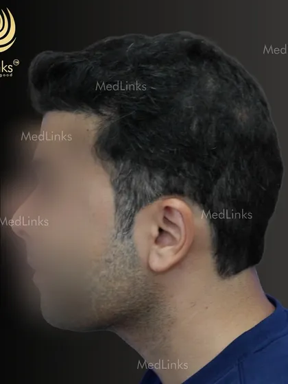 The 'after' shot from the side, showing a restored and natural hairline.
