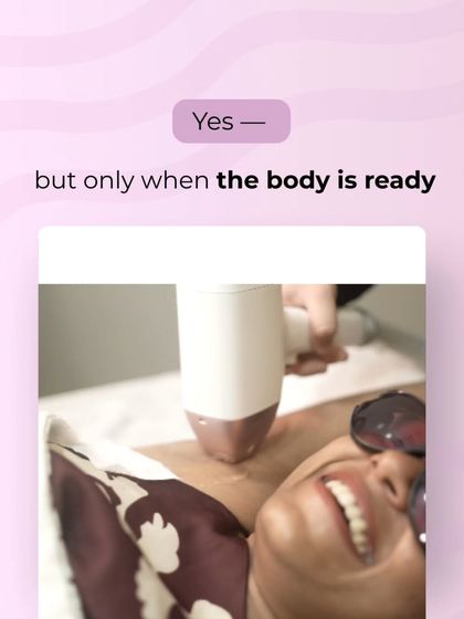 Yes, teenagers can get laser, but only when the body is ready. It is about building confidence early, but doing it safely and effectively.