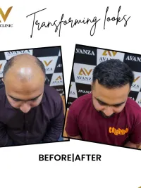 Hair & Beard Transplant Surgery