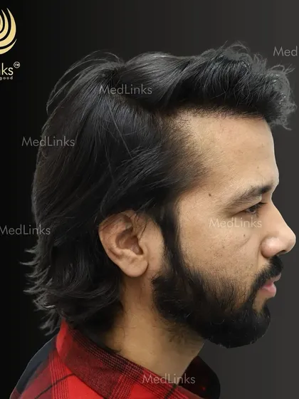 The final result from the side, showing a natural and dense hairline.