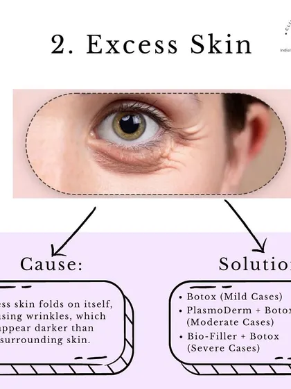 Problem: Excess Skin. Skin folds on itself, creating wrinkles that appear darker. We can treat this with Botox for mild cases, or a combination of PlasmoDerm and Botox for more moderate to severe cases.