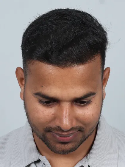 From Grade 5A baldness to bold confidence in just 7 months. This patient received 5850 grafts for a dense, natural-looking hairline.