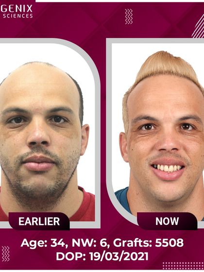 The full head hair transplant results for an international patient, showcasing a complete change with 5508 grafts.