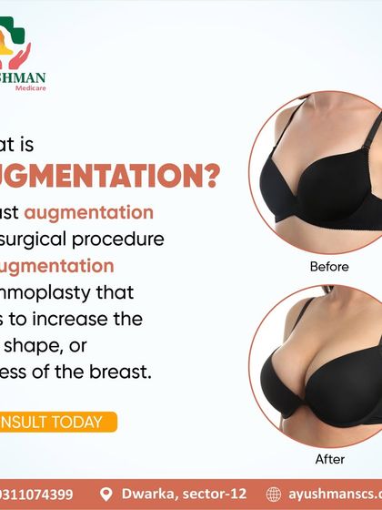 Breast augmentation, also known as augmentation mammoplasty, is a surgical procedure to increase the size, shape, or fullness of the breast. This before and after visual demonstrates the transformative potential of the treatment for achieving a more balanced figure.