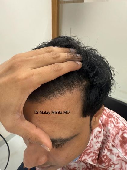 This patient's new hairline has been designed to suit his facial structure and age. The density is appropriate, and the angle of the transplanted hairs follows the natural direction of his original hair growth.