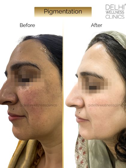 A side view of the same client, illustrating the successful reduction of dark spots and uneven tone on the cheek area after our personalized treatment.