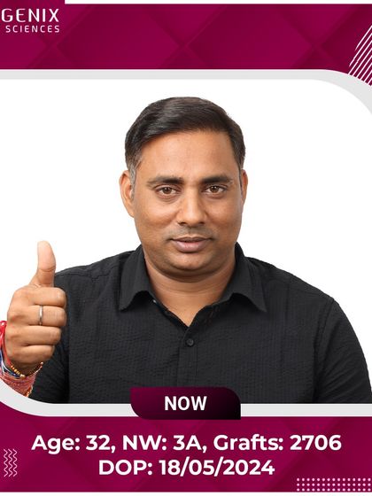 A 32-year-old patient's journey from Grade 3A baldness to a full, confident look after 2706 grafts.