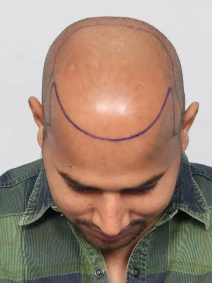 This shows the crucial first step: hairline design. We mark the area precisely to ensure the final result perfectly frames the face.