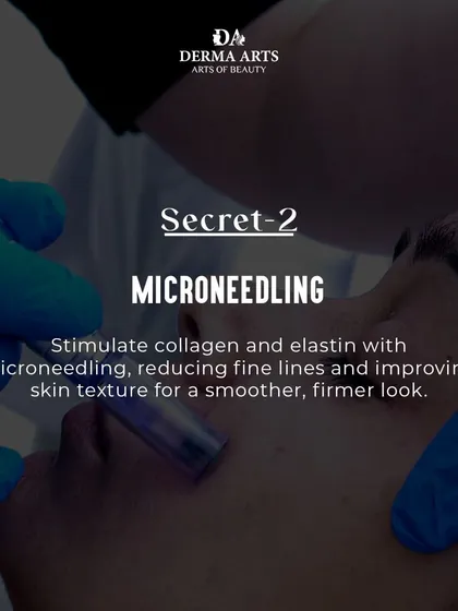 Microneedling stimulates collagen and elastin, reducing fine lines and improving skin texture for a smoother, firmer look.