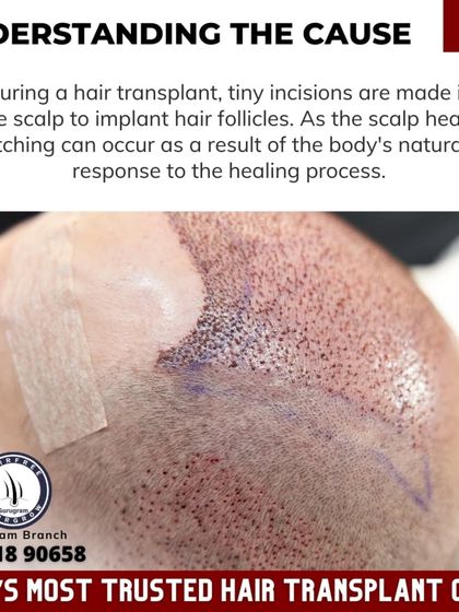 This graphic explains that itching is a natural response to the healing process after the tiny incisions are made to implant hair follicles.
