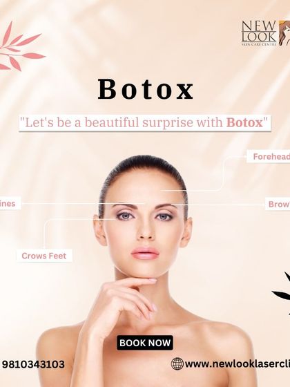 This graphic illustrates the common areas we treat with Botox. It is highly effective for relaxing muscles that cause forehead lines, frown lines, and crow's feet, and can also provide a subtle brow lift.