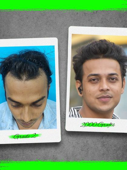 From Grade 2 baldness to a full head of hair with 2000 grafts. This patient's transformation showcases the natural and aesthetically pleasing results we deliver.