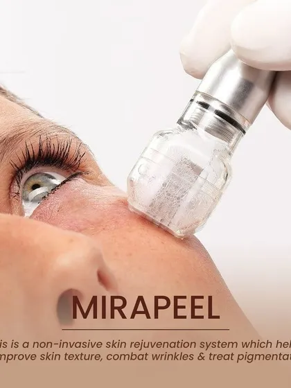 A close-up of the MiraPeel device during a procedure. This non-invasive system is highly effective for improving skin texture, combating wrinkles, and treating pigmentation, revealing a healthier complexion.