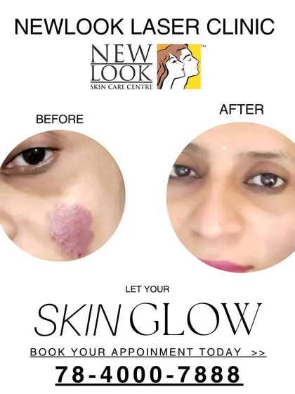 This before and after image showcases the significant reduction of a facial birthmark after treatment at our clinic. Our goal is to help you achieve clearer skin and renewed confidence with personalized dermatology solutions.