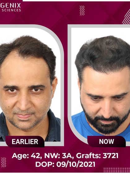 TV Actor Romanch Mehta shows his incredible transformation and explains how our results convinced him to overcome his fear of surgery.