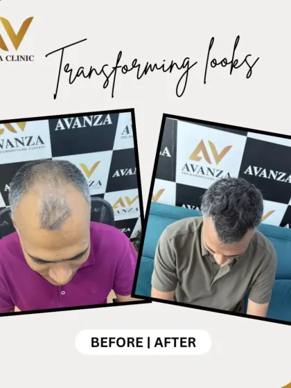 This client is now a "hair boss." We addressed the thinning on his crown and top, giving him a full head of hair that he can style with confidence.