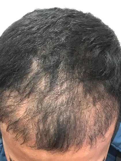 Two months after the procedure, you can already see significant growth and coverage. This image shows the early results of the transplant seen in the previous photo, on its way to becoming a full, dense head of hair.
